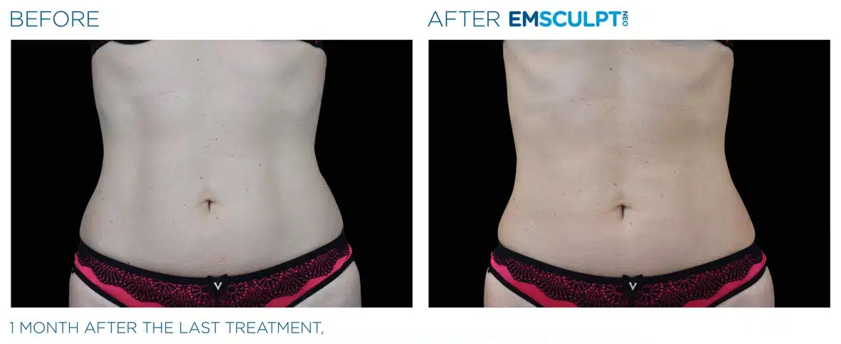 emsculpt-carousel-04